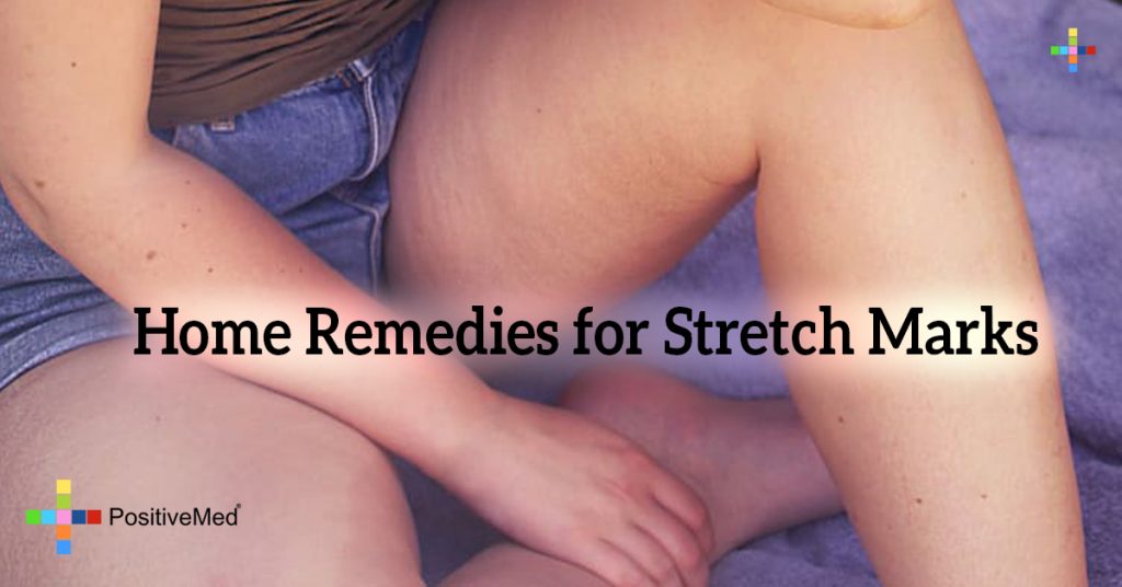 Home Remedies for Stretch Marks