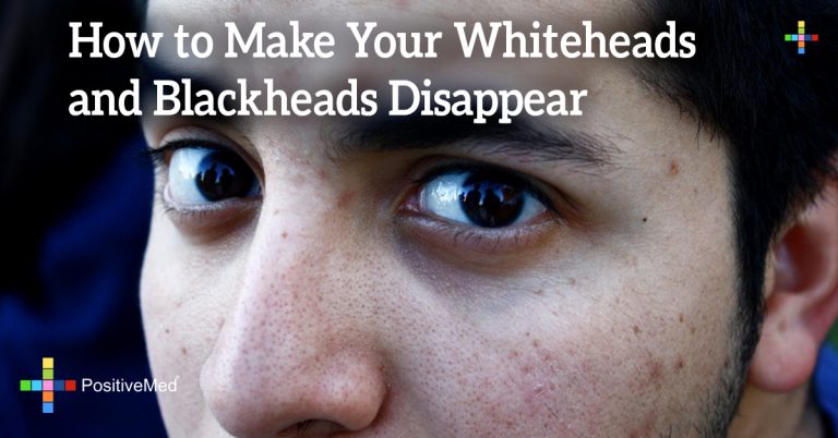 How to Make Your Whiteheads and Blackheads Disappear