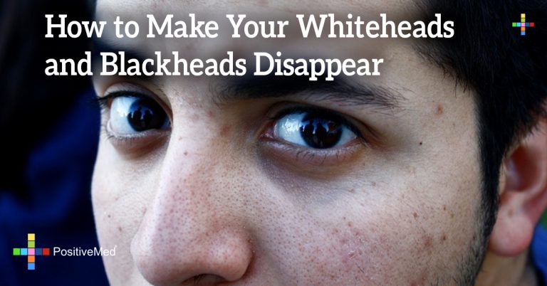 How to Make Your Whiteheads and Blackheads Disappear How to Make Your Whiteheads and Blackheads Disappear