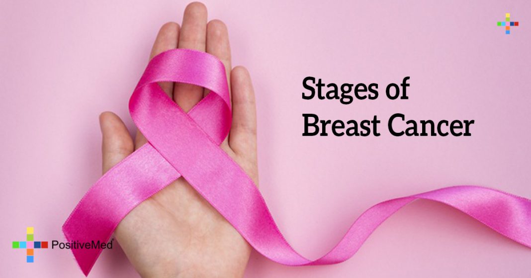 Stages of Breast Cancer
