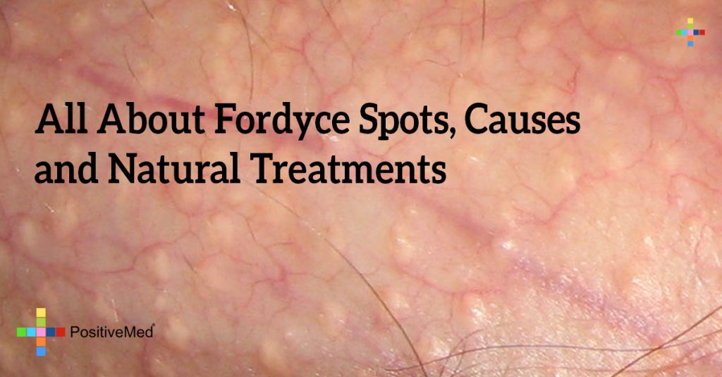 All About Fordyce Spots, Causes and Natural Treatments
