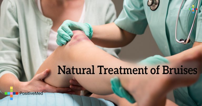 Natural Treatment of Bruises