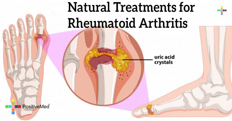 Natural Treatments for Rheumatoid Arthritis