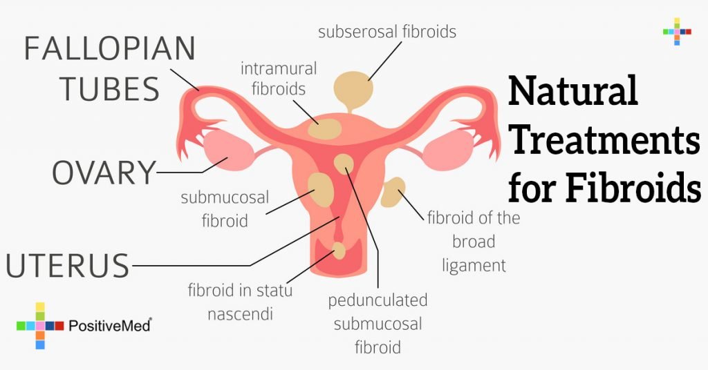 Natural Treatments for Fibroids