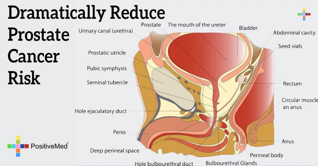 Dramatically Reduce Prostate Cancer Risk