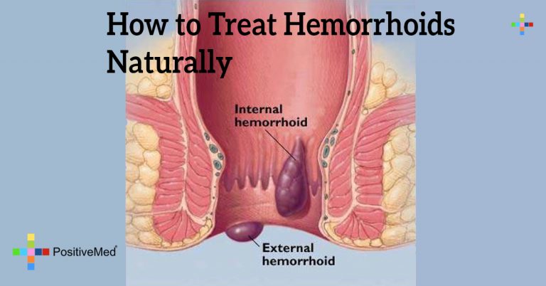 How to Treat Hemorrhoids Naturally