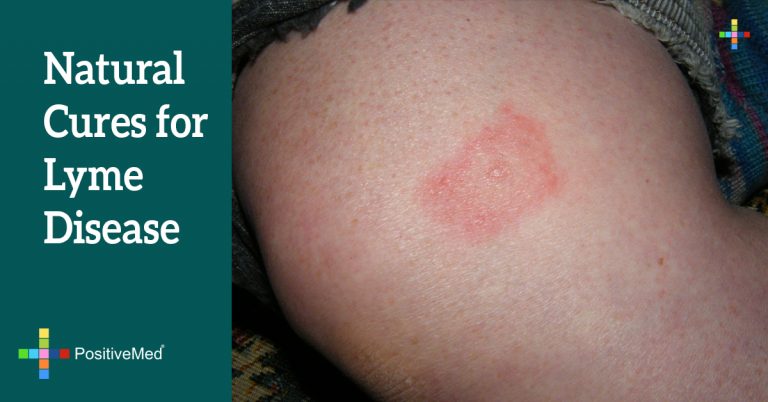 Natural Cures for Lyme Disease