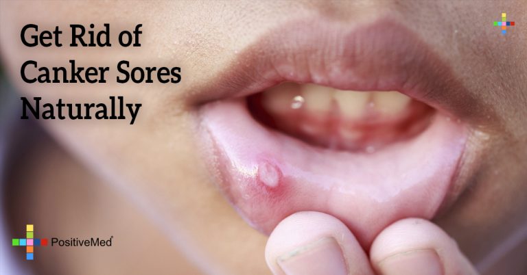 Get Rid of Canker Sores Naturally Get Rid of Canker Sores Naturally