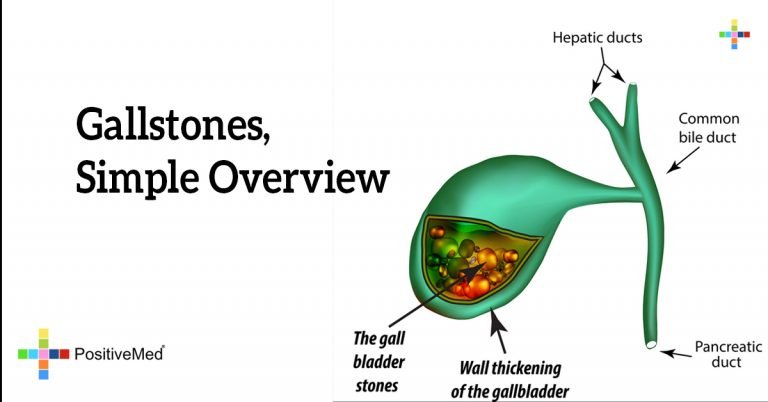 Gallstones, Simple Overview
