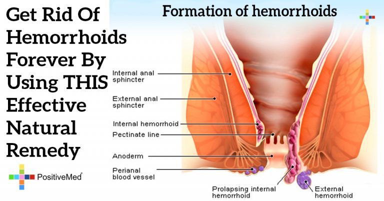 Get Rid Of Hemorrhoids Forever By Using THIS Effective Natural Remedy