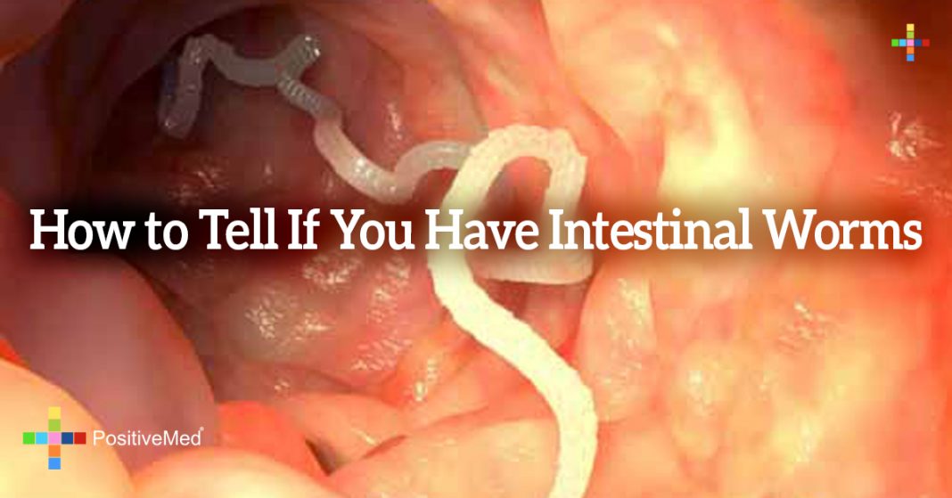 How to Tell If You Have Intestinal Worms PositiveMed