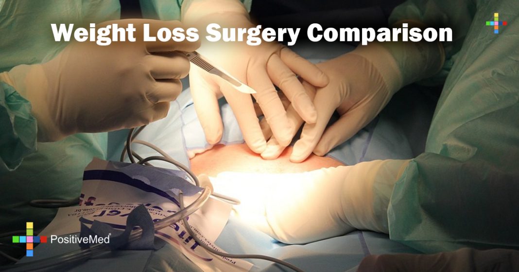 Weight Loss Surgery Comparison PositiveMed