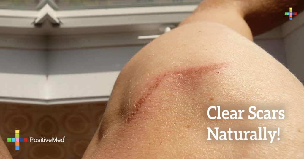 Clear Scars Naturally!