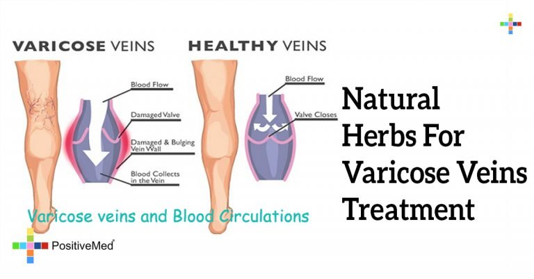 Natural Herbs For Varicose Veins Treatment