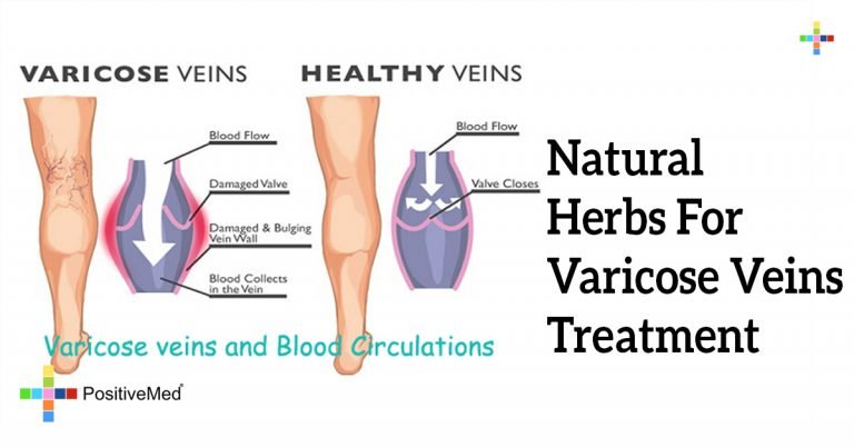 Natural Herbs For Varicose Veins Treatment Natural Herbs For Varicose Veins Treatment