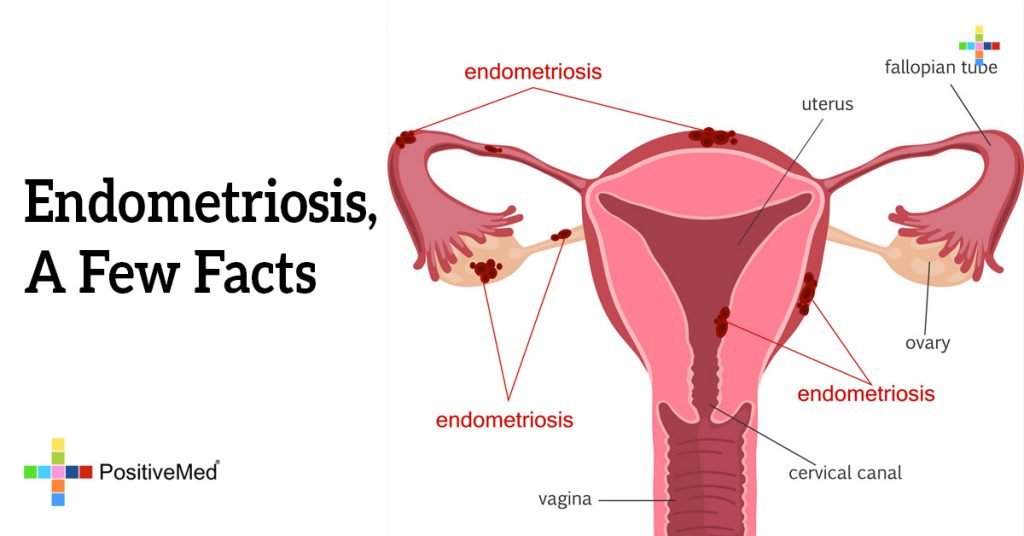 Endometriosis, A Few Facts