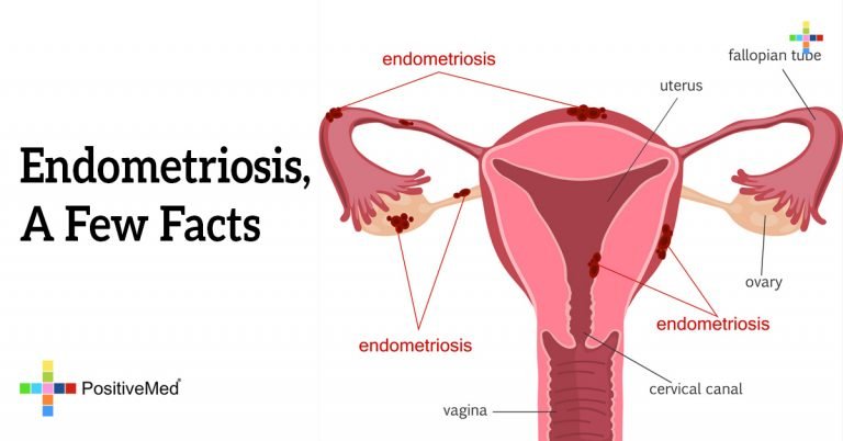 Endometriosis, A Few Facts Endometriosis, A Few Facts
