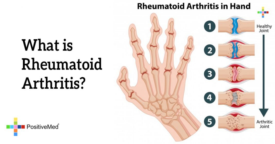 What is Rheumatoid Arthritis? PositiveMed