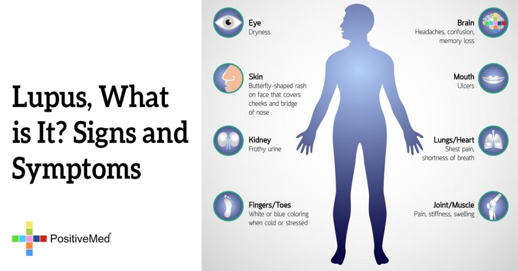Lupus, What is It? Signs and Symptoms PositiveMed