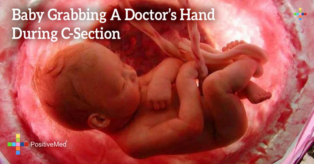 Baby Grabbing A Doctor’s Hand During C-Section