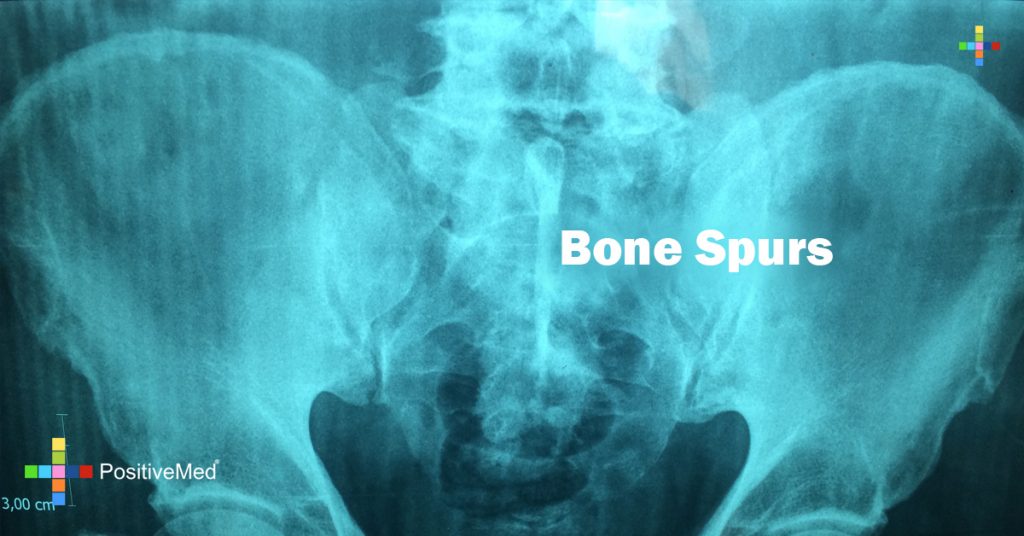 Bone Spurs