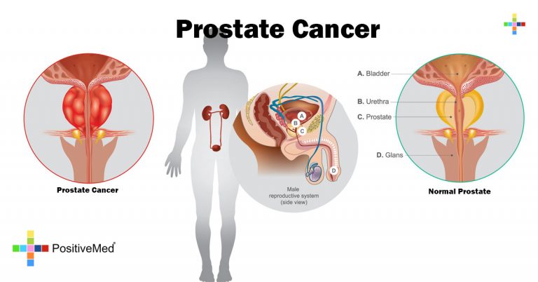 Prostate Cancer Prostate Cancer