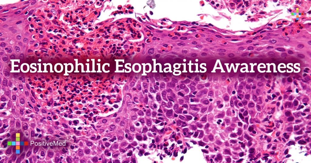 Eosinophilic Esophagitis Awareness