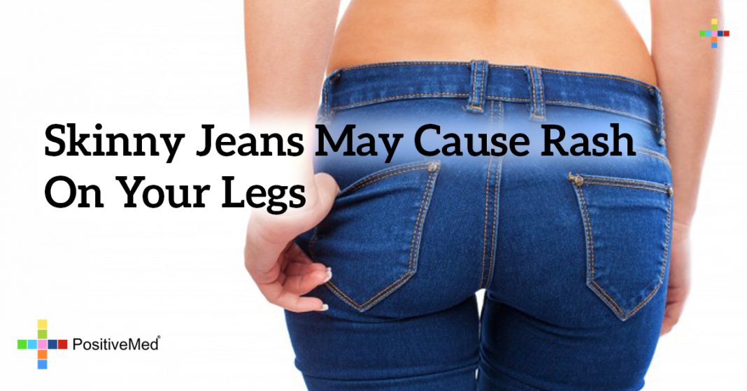 Skinny jeans may cause rash on your legs PositiveMed