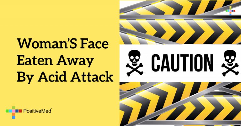 Woman’s Face Eaten Away By Acid Attack Woman’s Face Eaten Away By Acid Attack
